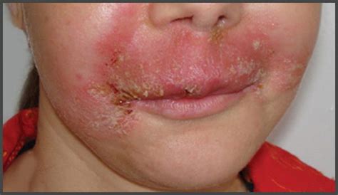 Psoriasis On Lips Pictures Psoriasis Expert