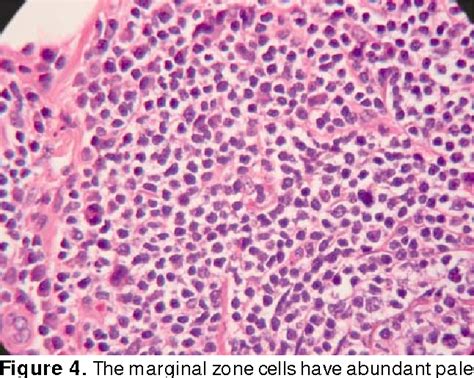 Figure 3 From Primary Cutaneous Marginal Zone B Cell Lymphoma