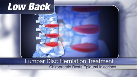 Video Chiropractic Better Than Epidural Injections For Back Pain