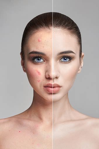 Pimples And Acne On The Womans Face Before And After Cosmetics To