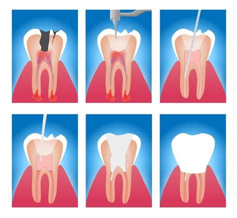 牙齒根管治療後，長期不戴牙套可以嗎？no牙齒裂開的風險較大 每日頭條