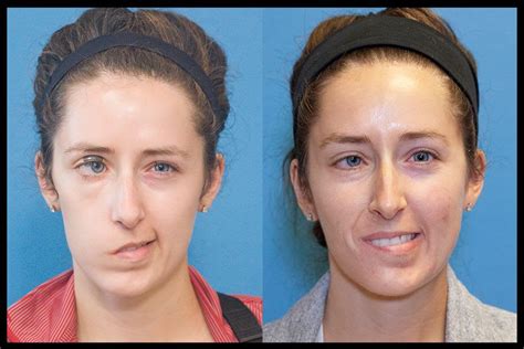 Bell S Palsy Facial Nerve Face Exercises Paralyzed Fa Vrogue Co