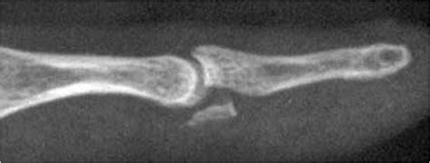 The injury is common when one athlete grabs another player's jersey with the tips of one or more fingers while. Lésions tendineuses - Jersey finger ou Rugby finger | La ...