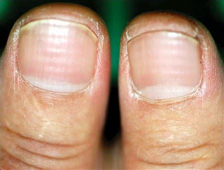 If you notice that your fingernails start to develop vertical otherwise known as. Pielęgnacja włosów wypadających i wysokoporowatych ...
