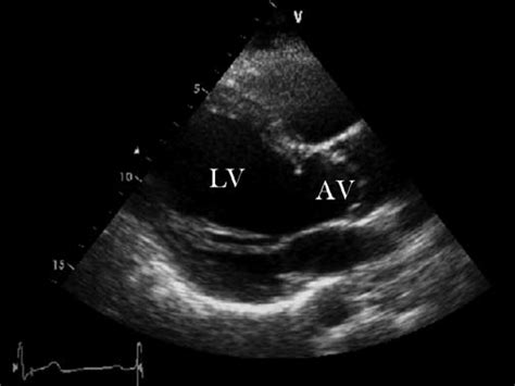 Transthoracic Echocardiaography Showing A Unicuspid Aortic Valve With A
