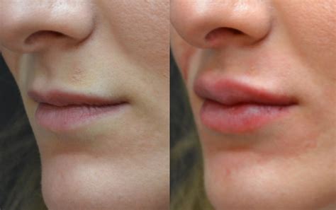 Lip Fillers Before And After Healthy B Daily