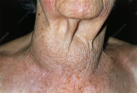 Elderly Womans Swollen Neck Due To Thyroid Cancer Stock Image M131