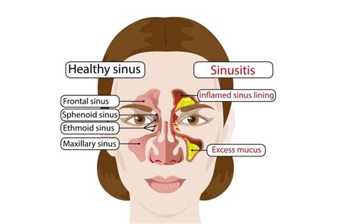 7 Causes Of Chronic Sinusitis