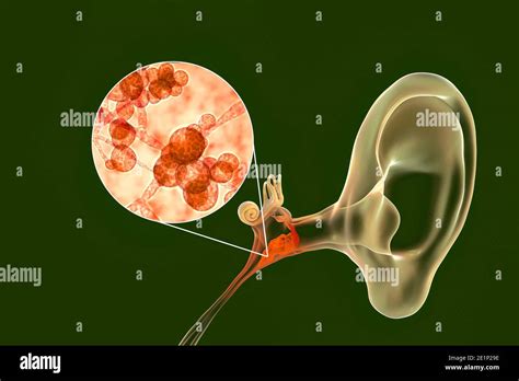 Chronic Fungal Otitis Media Ear Infection Illustration Stock Photo Alamy