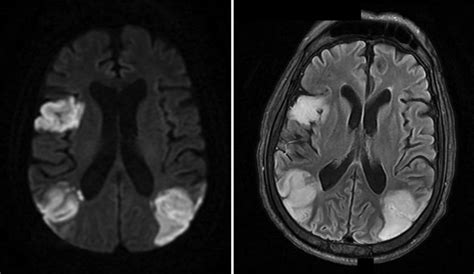 Ischemic Strokes In A Patient With Covid 19 Mri Brain In A Patient
