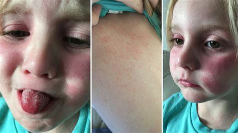 Schools And Nurseries Warned Over Scarlet Fever Rise Bbc News