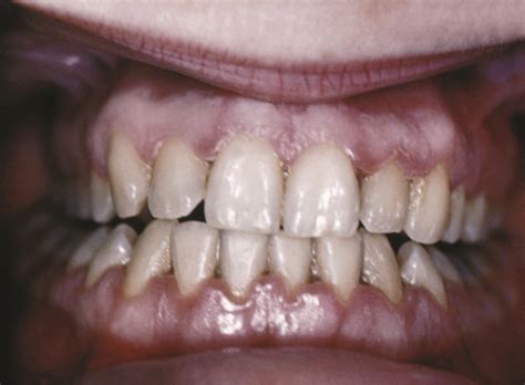 Microbial Diseases Of The Mouth And Oral Cavity · Microbiology