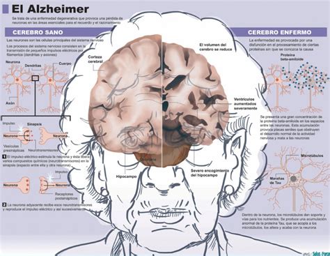 El Alzheimer Vivir Con La Demencia Salud Ediciones