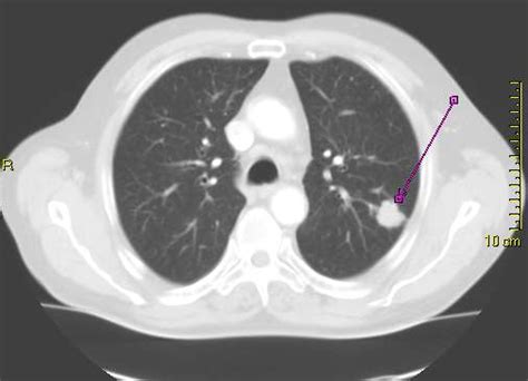 Lung Cancer Ct Wikidoc