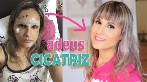 Contractubex Antes E Depois