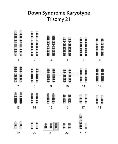 Down Syndrome Trisomy 21 Human Karyotype Stock Illustration Illustration Of Human