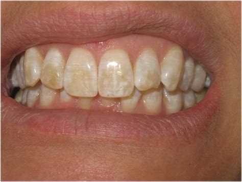 Black Stains On Teeth Causes Slide Share
