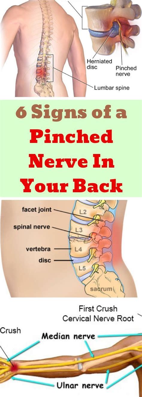 Here Are 6 Signs Of A Pinched Nerve In Your Back Famous Comedy Humor
