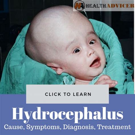 List 91 Images Pictures Of Hydrocephalus In Adults Completed