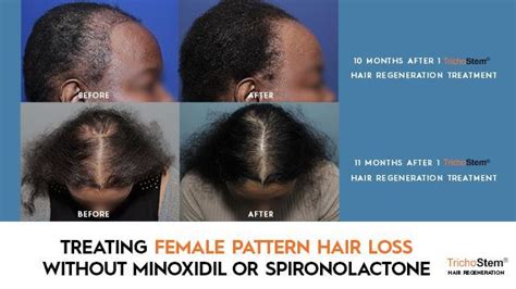 Part 2 Treating Female Pattern Hair Loss Without Minoxidil Or