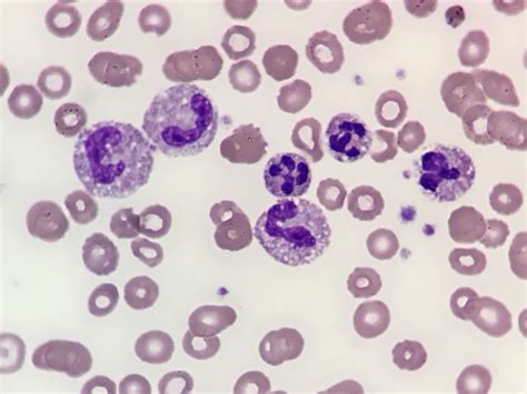 What Causes Toxic Granulation Of Neutrophils