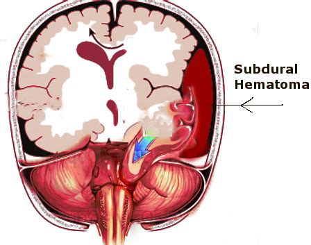 Figure Subdural Hematoma And Uncal Herniation Image Courtesy S Bhimji