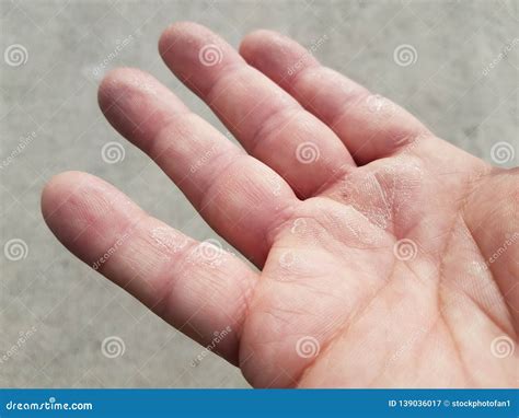 Dry Flaky Itchy And Peeling Fingers On Hand Stock Image Image Of