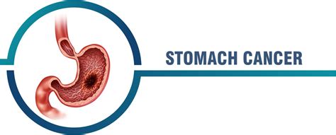 Stomach Cancer Global Care
