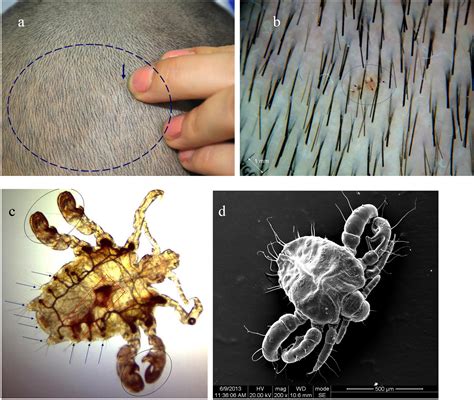 Parasites On Scalp Pictures Skin Health The Creatures That Live On