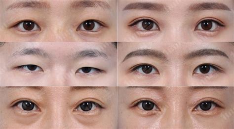 korean double eyelids surgery guide to different surgical methods eunogo