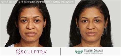 Vancouver Sculptra Aesthetic For Non Invasive Face Lifts In Surrey