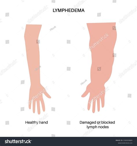 Hand Lymphedema Disease Concept Swelling Female Stock Vector Royalty