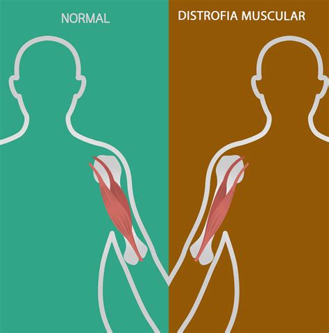 Distrofia Muscular De Duchenne Images And Photos Finder