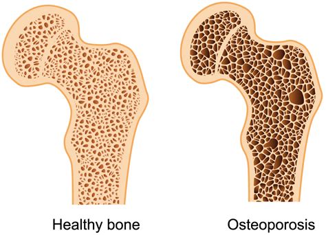 What Are Osteoporosis And Osteopenia Orthopaedic And Spine Center Of