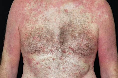 Eczema On The Torso Photograph By Dr P Marazziscience Photo Library