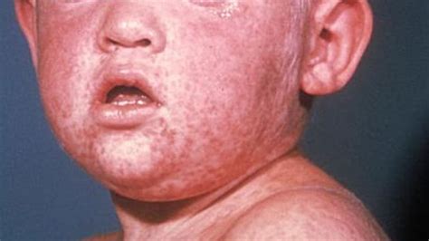 Measles Alert Four People With Measles Have Been In Planes Surgeries