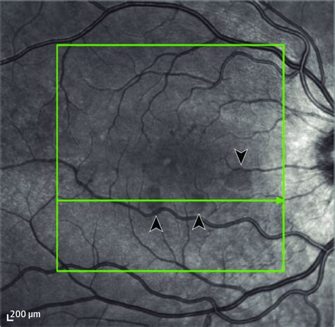 Figure A Near Infrared Reflectance Imaging Of Acute Macular