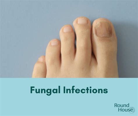 Fungal Infections And Feet Round House Podiatry