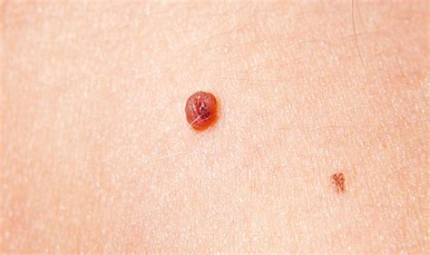Molescope's imaging app for skin cancer moles comes with preloaded skin cancer images and pictures of cancerous moles to help your dermatologist check for early skin cancer signs and symptoms. Skin cancer symptoms: Tumour cases rise - signs to look ...