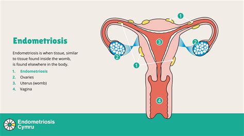 What Is Endometriosis Endo Cymru