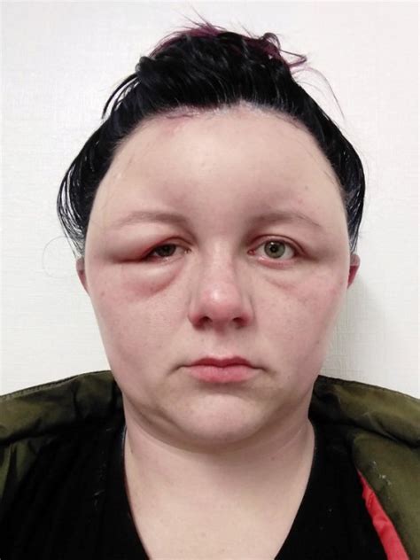 Hair Dye Reaction Leaves Woman With Blistered Scalp And Swollen Eyes