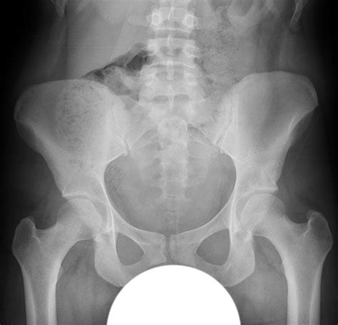 Surgical Dislocation Of The Hip Surgery For Complex Conditions That