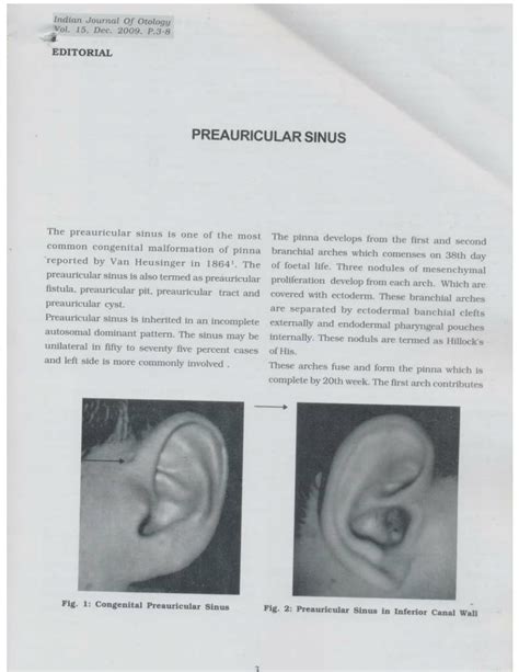 Pdf Preauricular Sinus