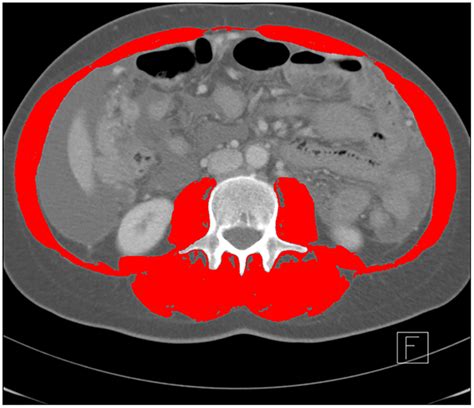 Example Of An Axial Computed Tomography Ct Image Of The Third Lumbar