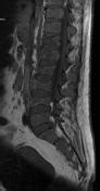 Learn more about the symptoms, causes, diagnosis, risk factors, and treatment of multiple myeloma. Multiple myeloma | Radiology Reference Article ...