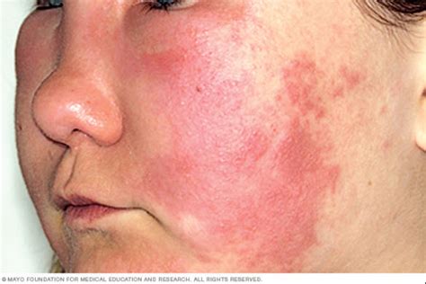 Hives Skin Inflammation Causes Symptoms And Treatments