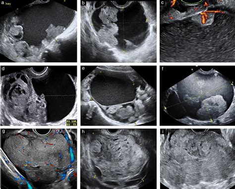 Ovarian Cancer Ultrasound Vs Normal The Characteristic Ultrasound Features Of Specific Types