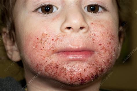 Atopic Dermatitis On Face Of A Child Stock Image C0110355