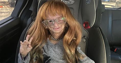 Adalia Rose Williams La Youtuber Affetta Da Progeria è Morta Bigodino