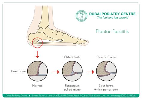 Plantar Fasciitis Orthotic Dubai Podiatry Centre